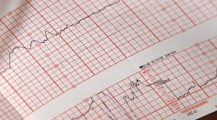 apple, watch, watch 5, ekg