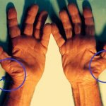Untreated-Carpal-Tunnel-Syndrome-731×547